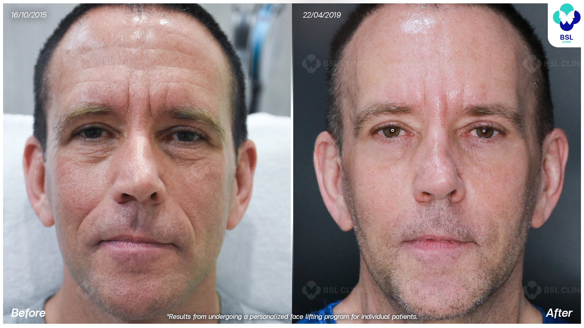 โปรแกรมยกหน้าโดยไม่ต้องผ่าตัด