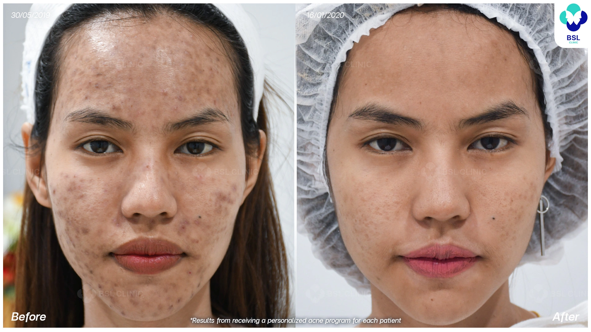 โปรแกรมรักษารอยดำสิว