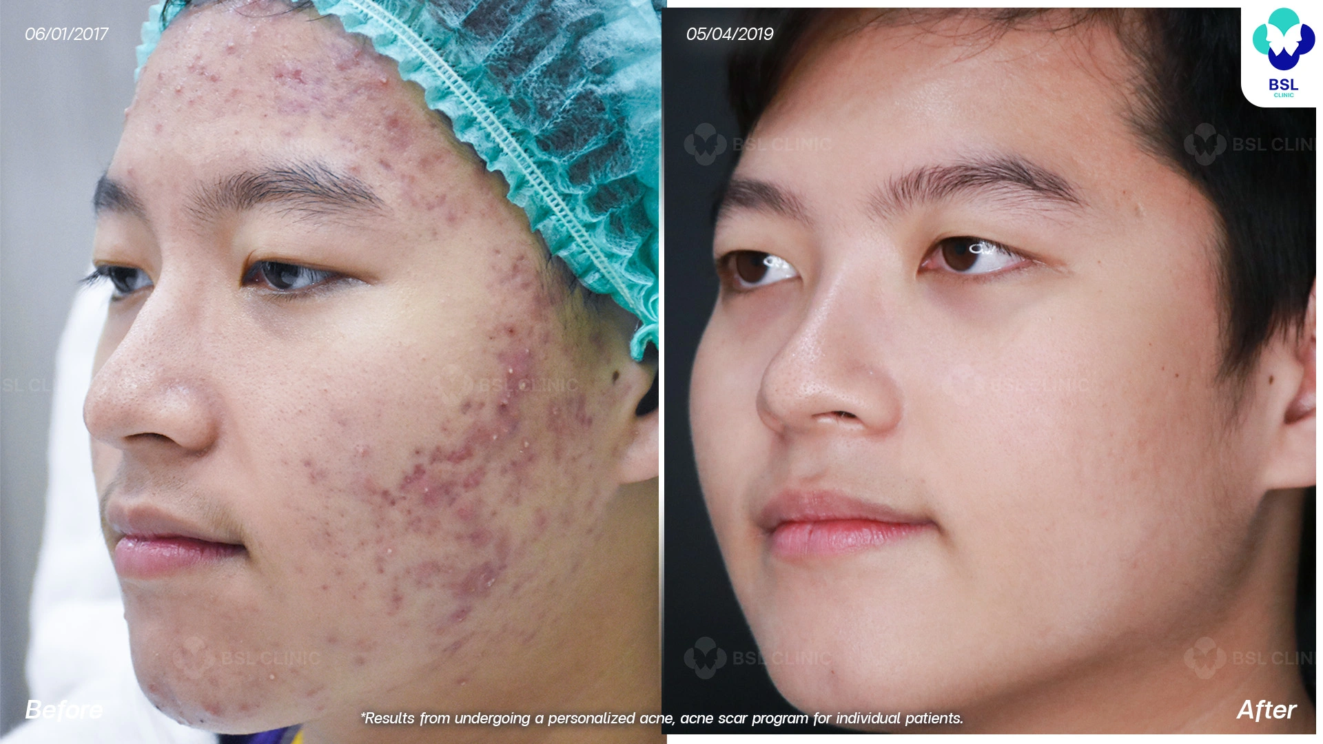 โปรแกรมรักษาเส้นเลือดฝอย ปานแดง หน้าแดง สิวอักเสบ หลุมสิว