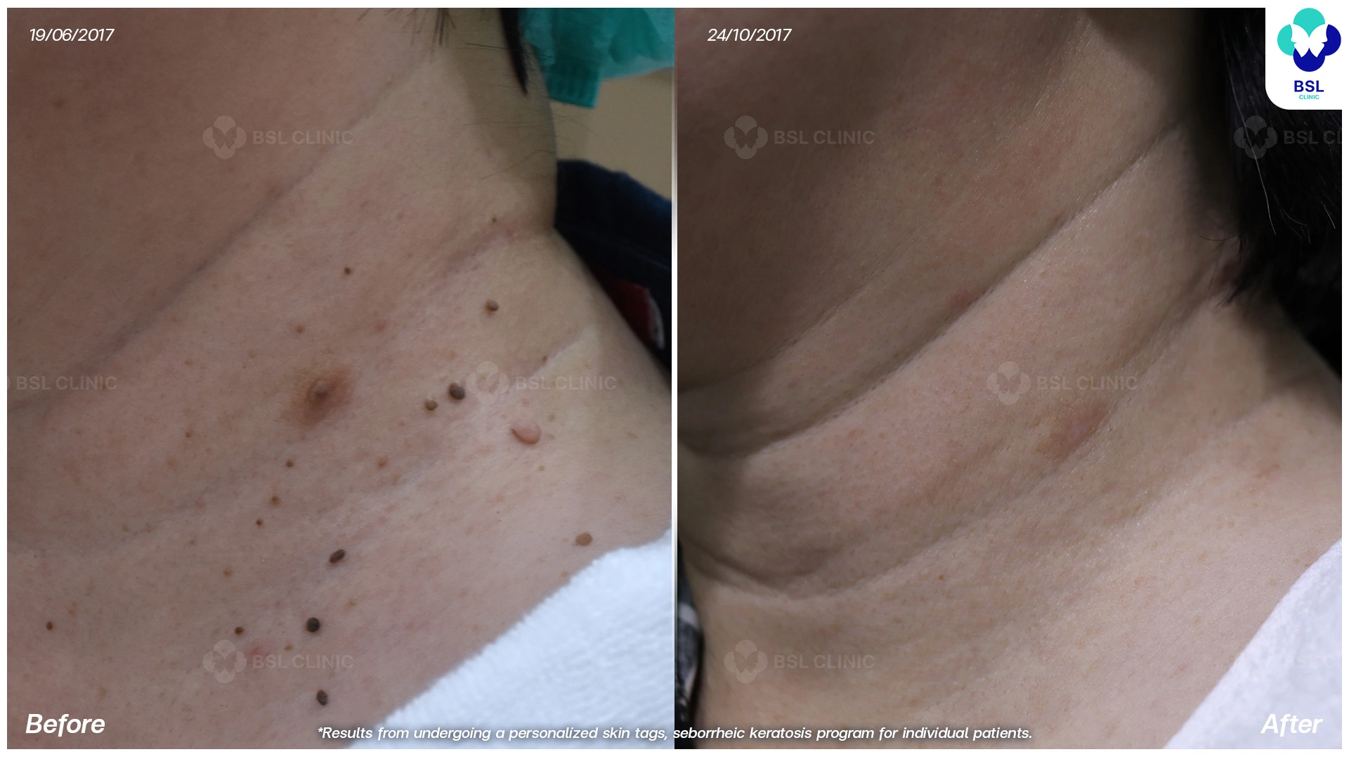 โปรแกรมรักษาไฝ ขี้แมลงวัน ติ่งเนื้อ กระเนื้อ ต่อมเหงื่อใต้ตา