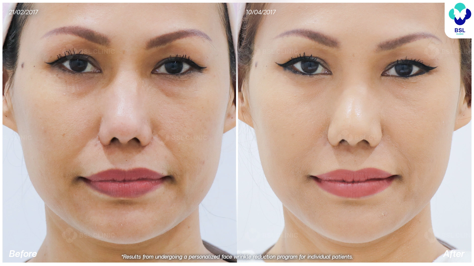 โปรแกรมลดริ้วรอยบนใบหน้า