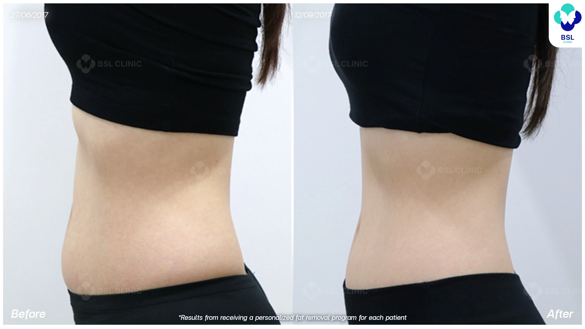 โปรแกรมลดหน้าท้อง