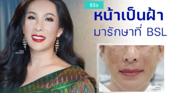 รีวิวรักษาฝ้ากระ