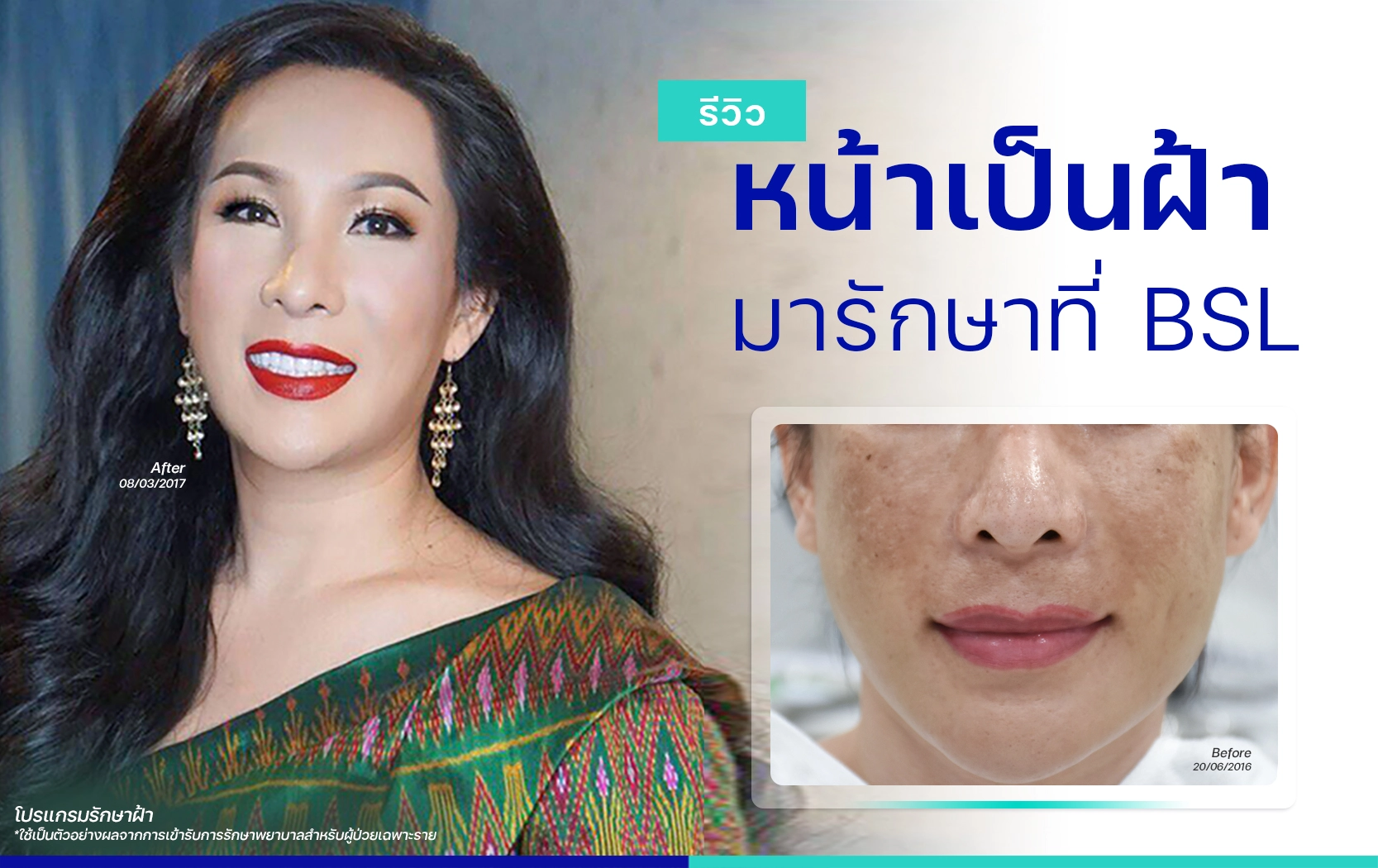 รีวิวรักษาฝ้ากระ