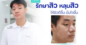 รีวิวรักษาสิว
