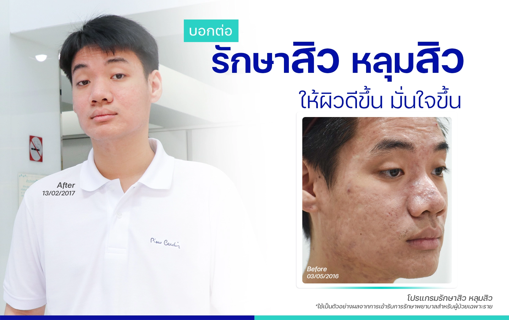 รีวิวรักษาสิว