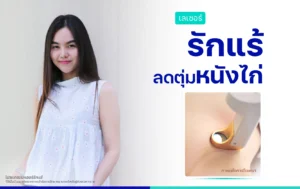 รีวิวเลเซอร์รักแร้