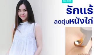 รีวิวเลเซอร์รักแร้