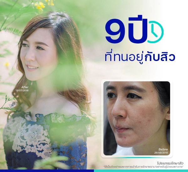 รีวิวรักษาสิว
