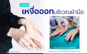 รีวิวรักษาเหงื่อออกมือ