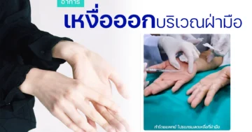 รีวิวรักษาเหงื่อออกมือ