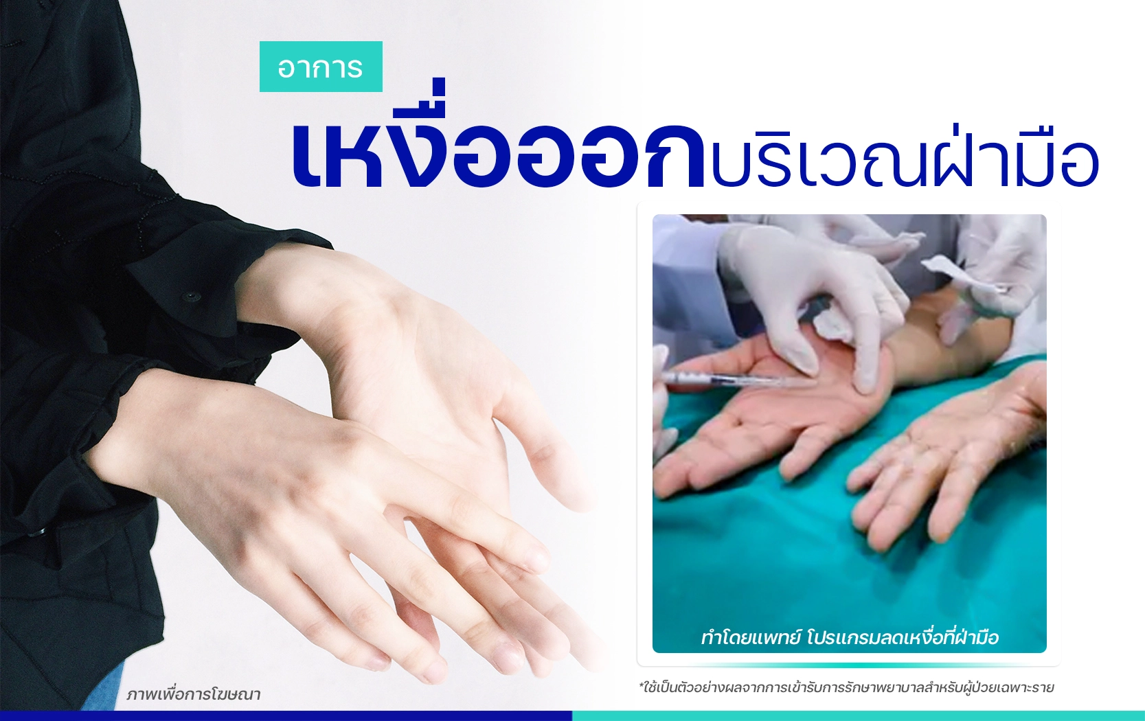 รีวิวรักษาเหงื่อออกมือ