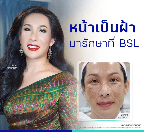 รีวิวฝ้า