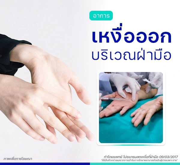 รีวิวลดเหงื่อที่มือ