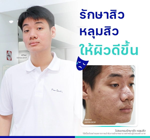รีวิวรักษาสิว หลุมสิว