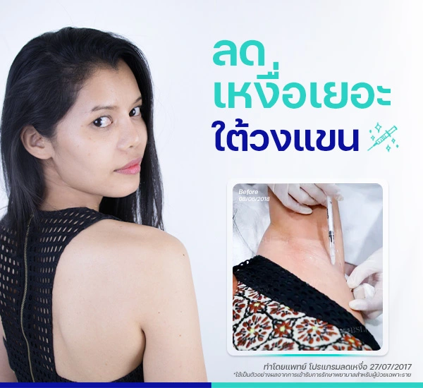 รีวิวลดเหงื่อรักแร้