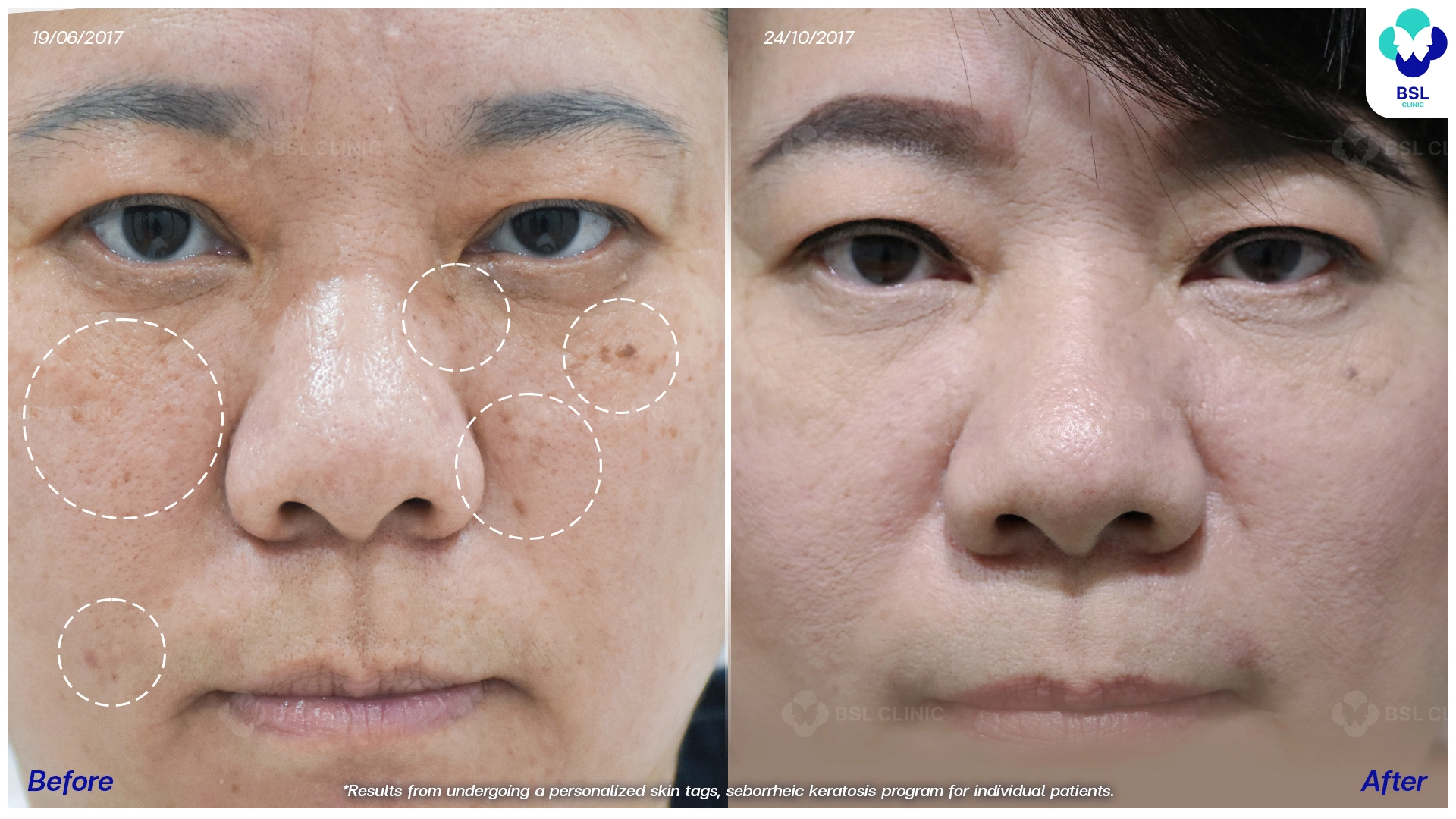 รีวิวจี้ติ่งเนื้อ