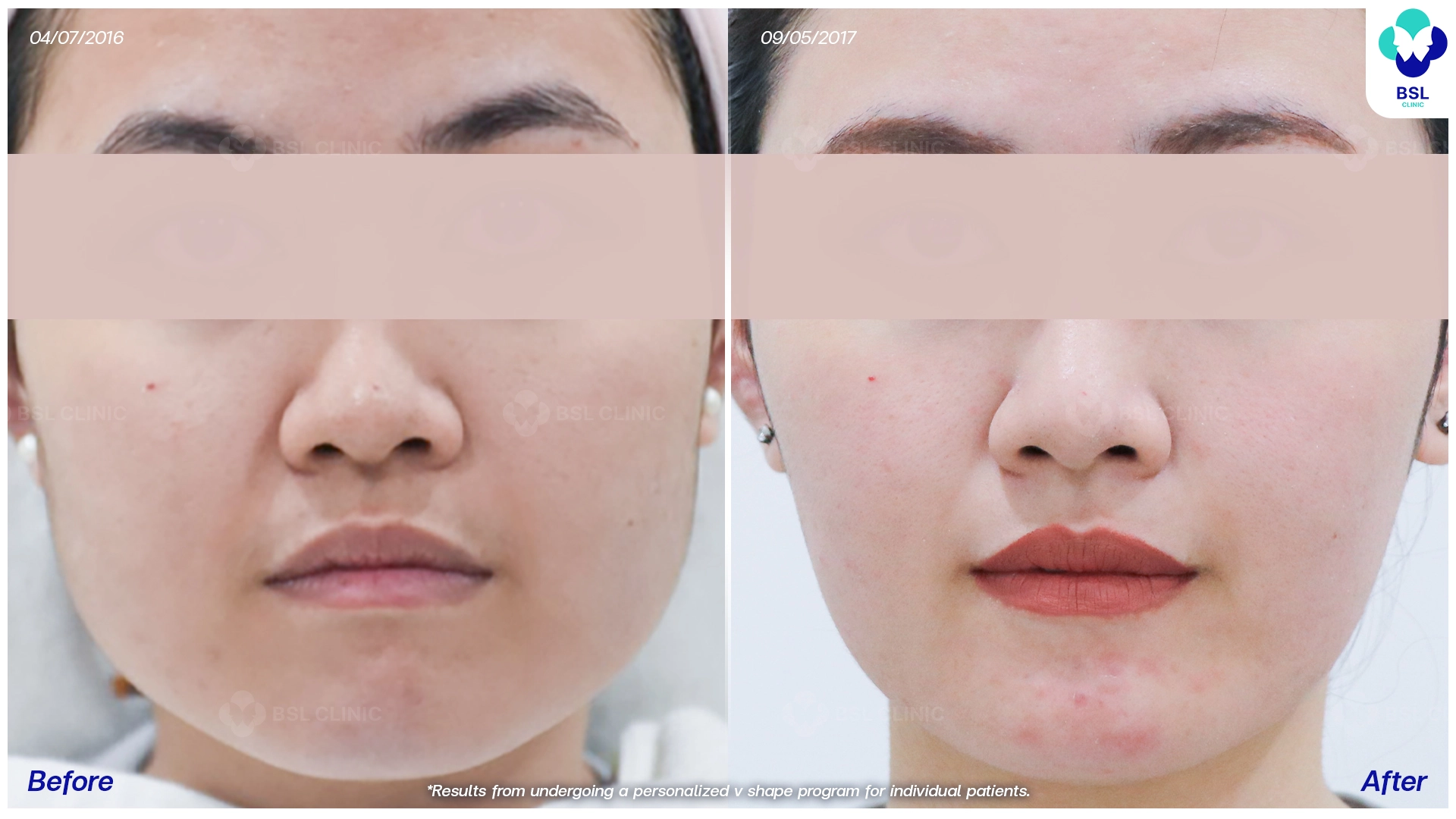 รีวิวหน้าเรียว