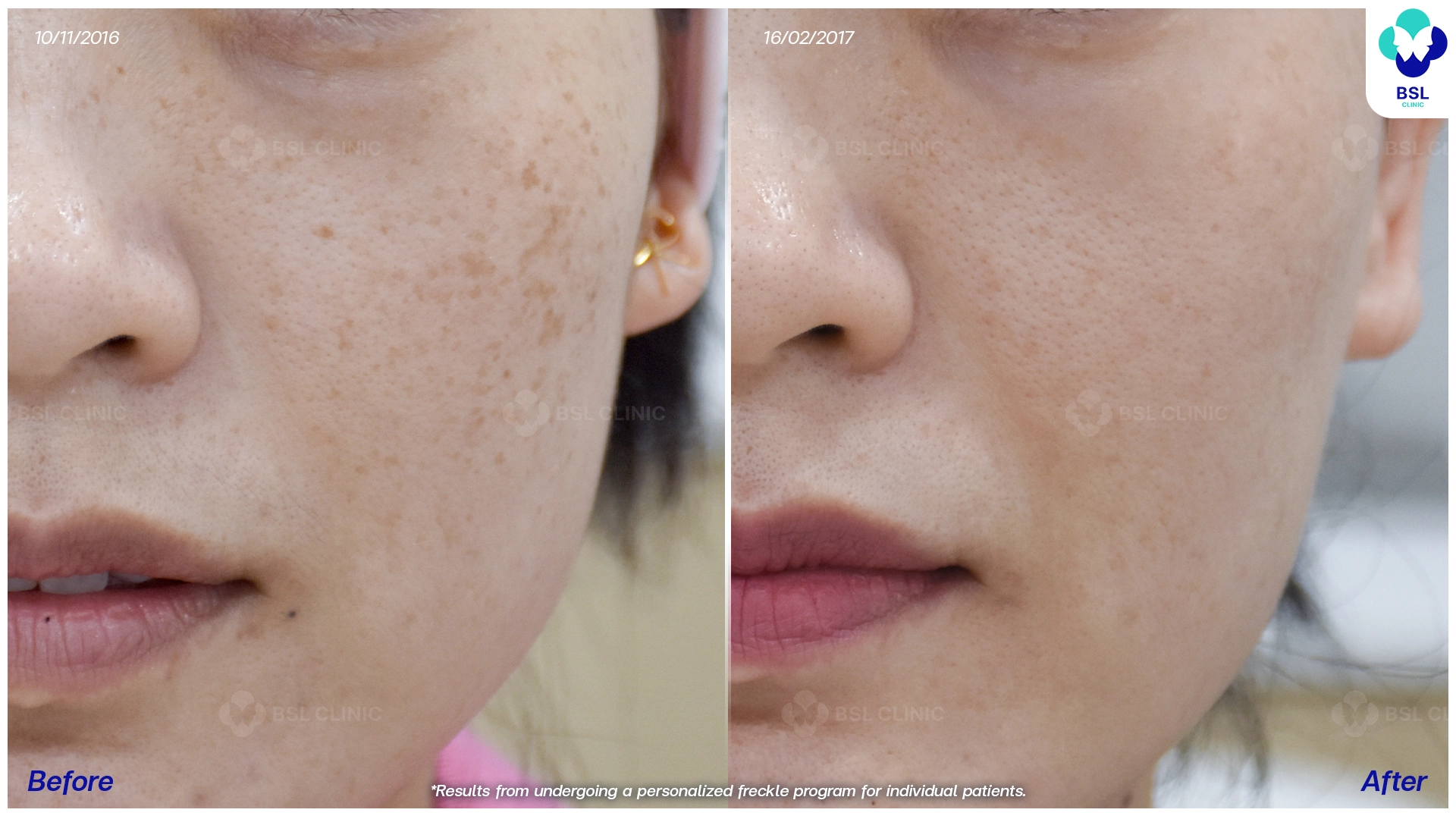 รีวิวรักษากระ