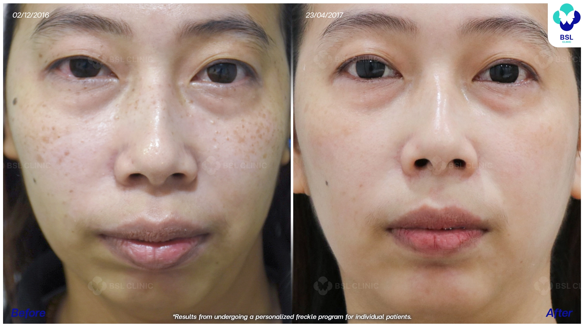 รีวิวเลเซอร์กระตื้น