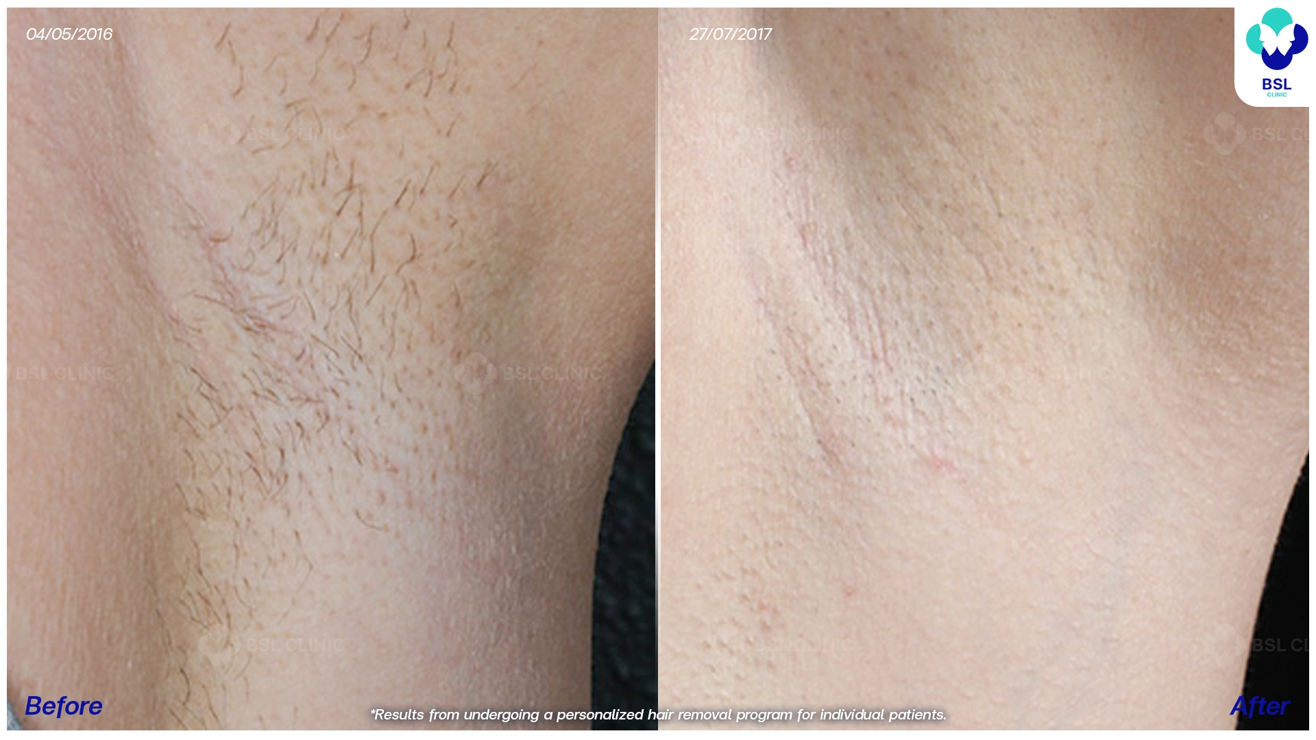 รักแร้เนียน