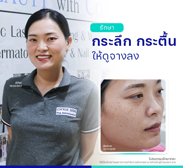 รีวิวรักษากระ