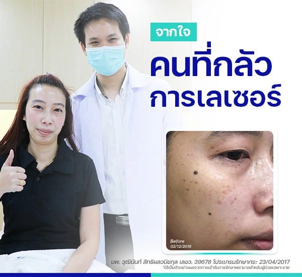 รักษากระ ฝ้า