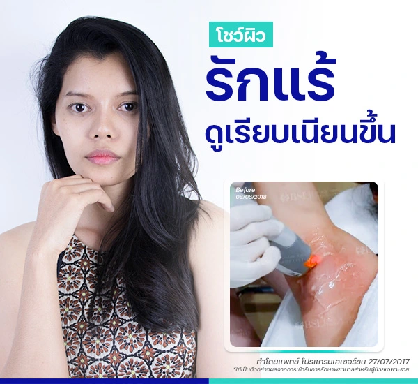 รีวิวรักแร้เนียน