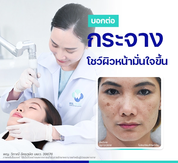 รักษากระ