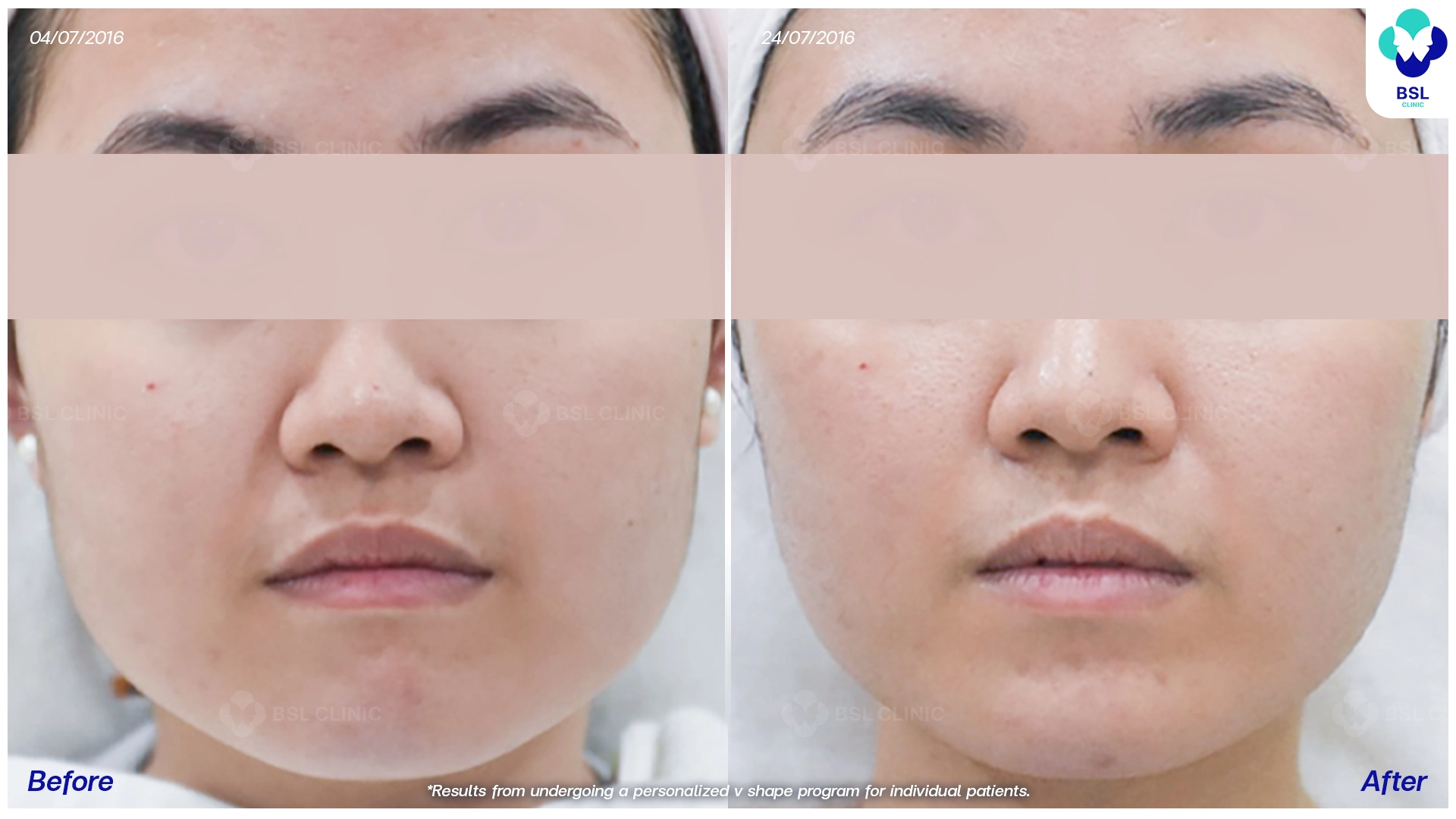 รีวิวหน้าเรียว