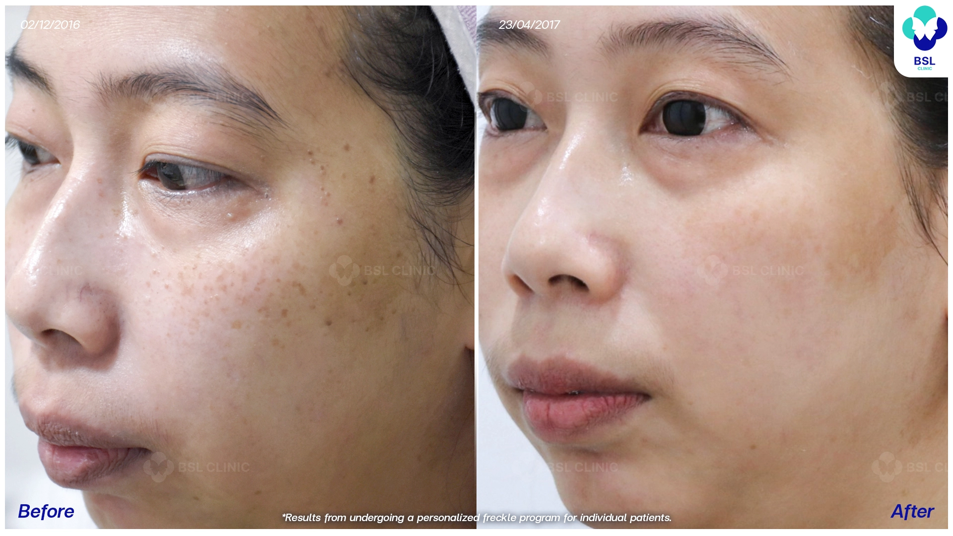 รีวิวเลเซอร์กระตื้น