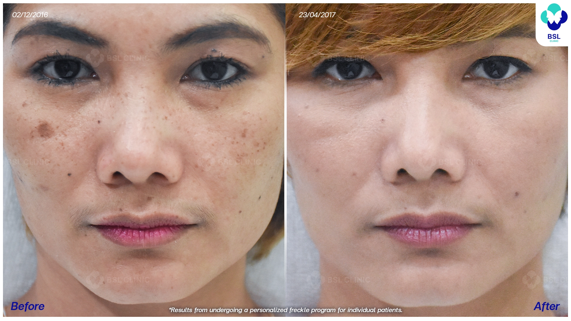 รีวิวกระฝ้า