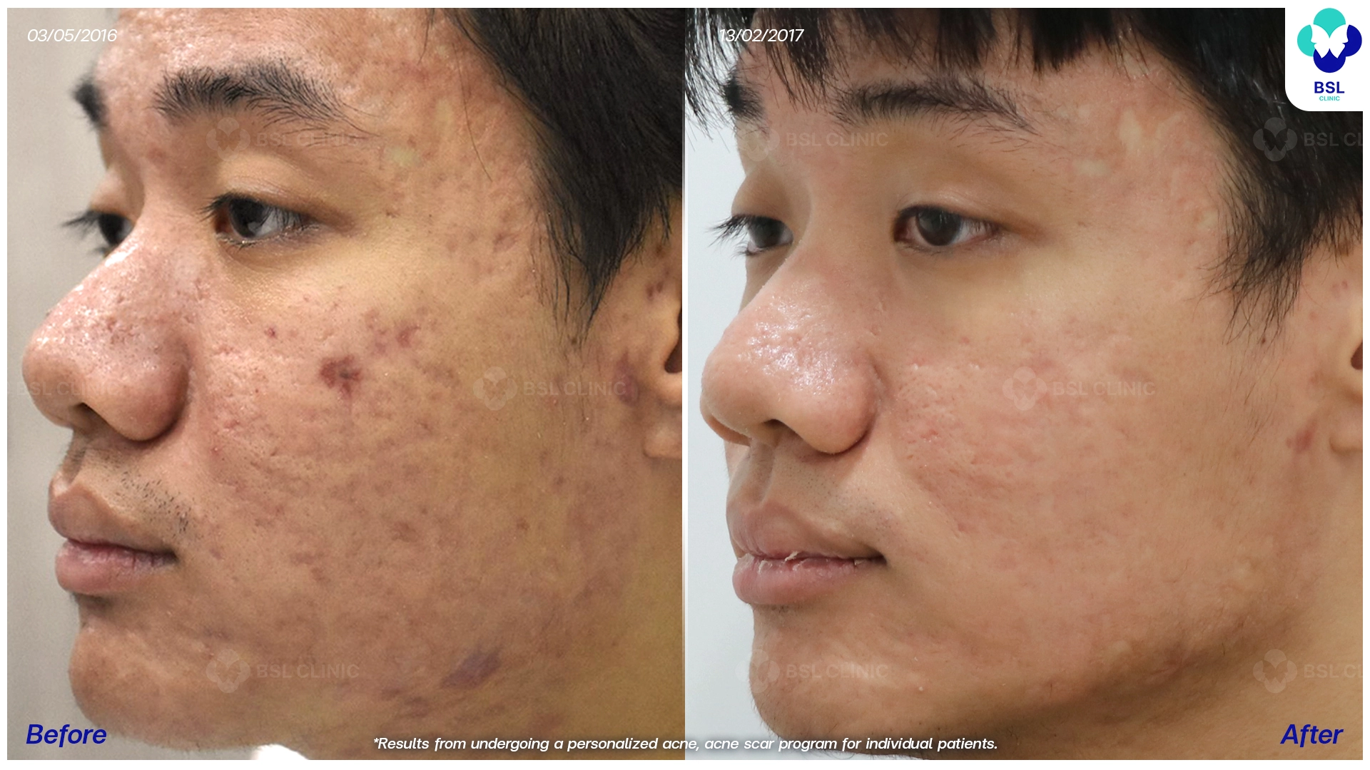 รีวิวรักษาสิว