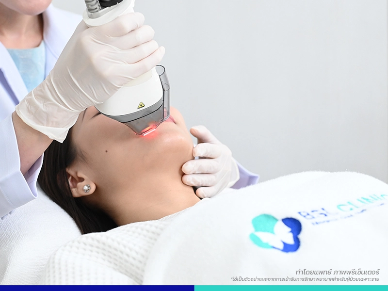 เลเซอร์หน้าใส