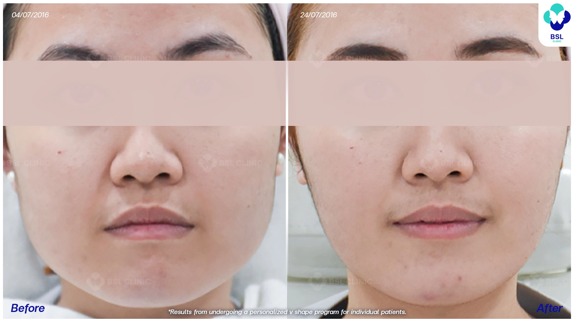 รีวิวหน้าเรียว