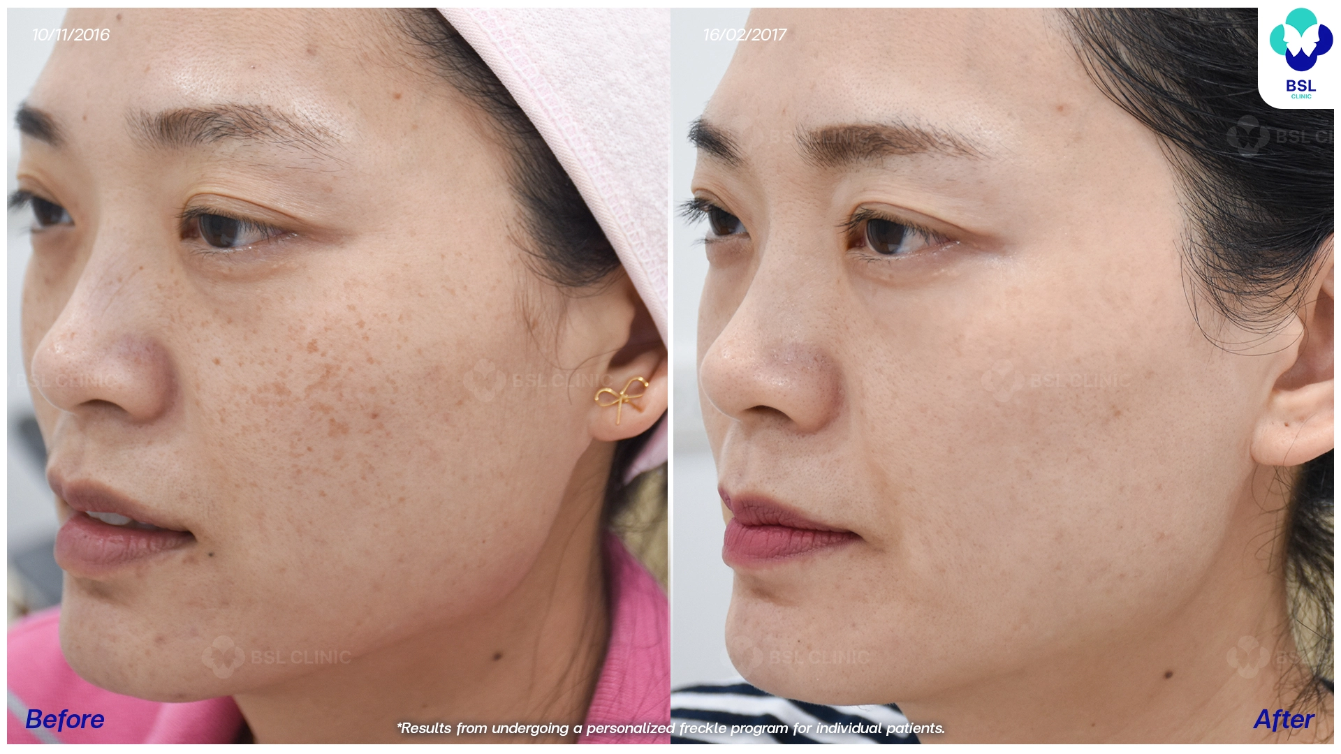 รีวิวรักษากระ