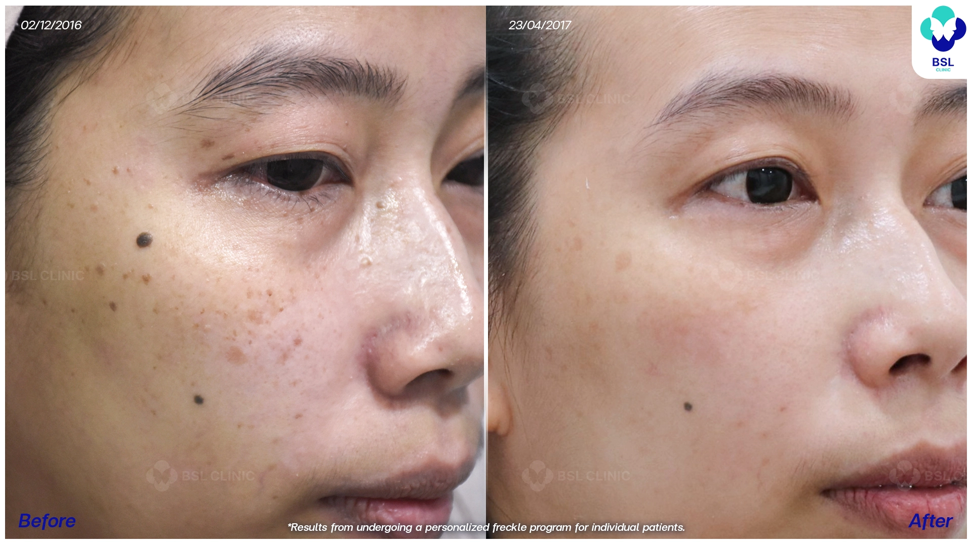 รีวิวเลเซอร์กระตื้น