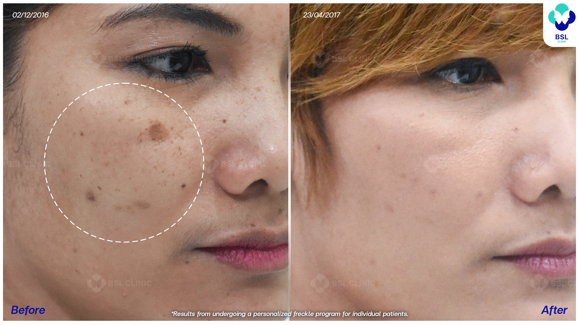 รีวิวรักษากระ