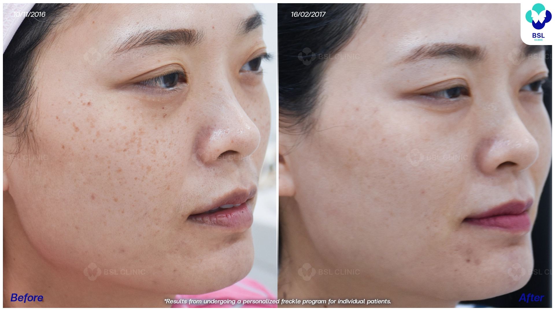 รีวิวรักษากระ