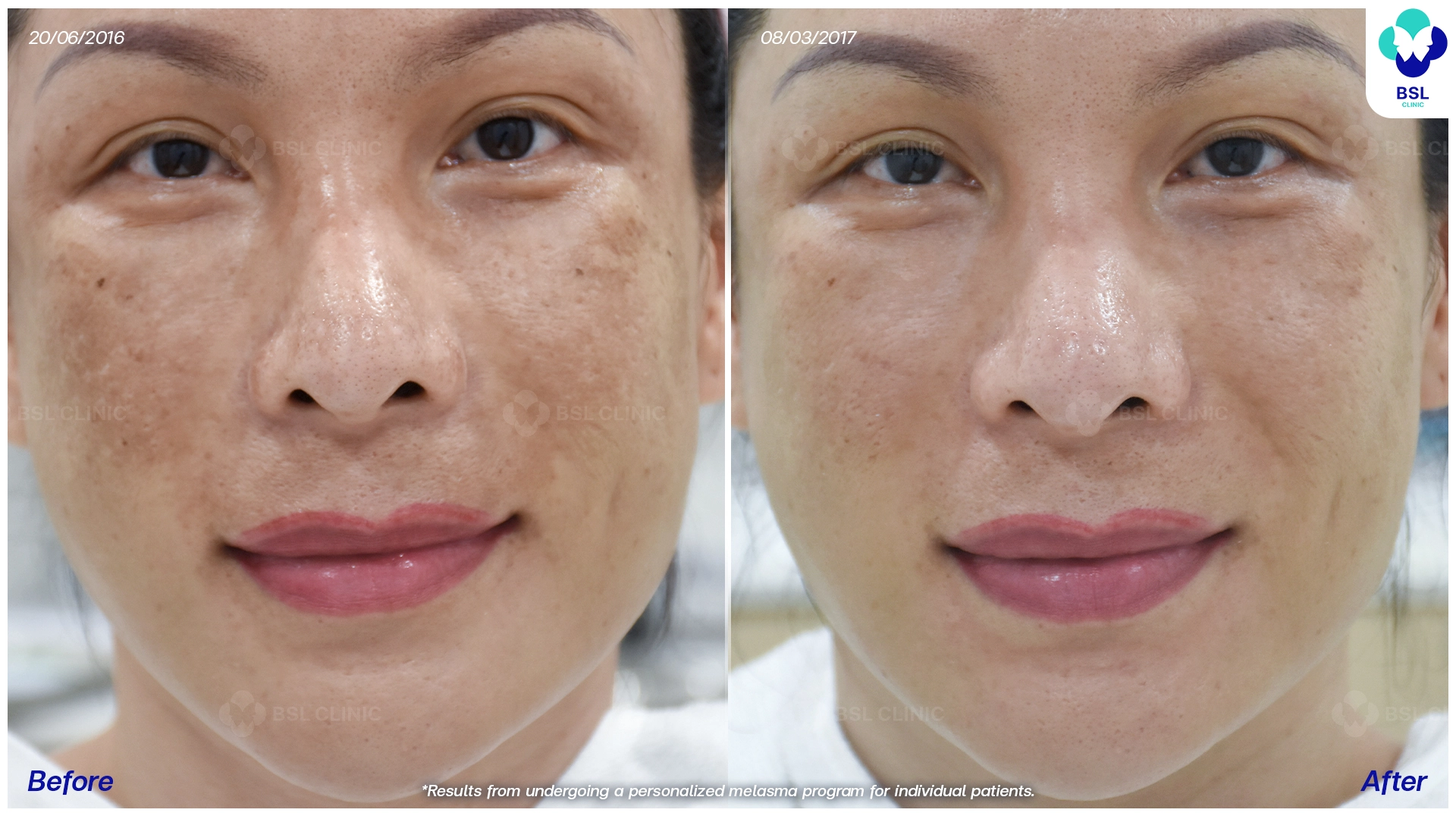 รีวิวรักษาฝ้ากระ