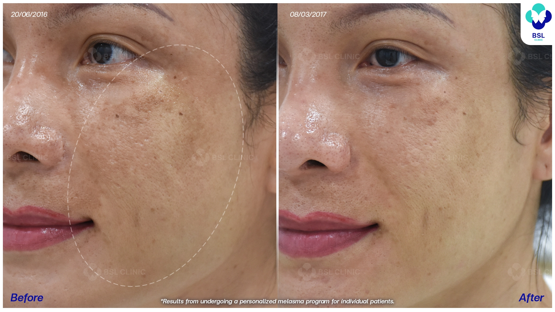 ผลลัพธ์รีวิวรักษาฝ้า กระ