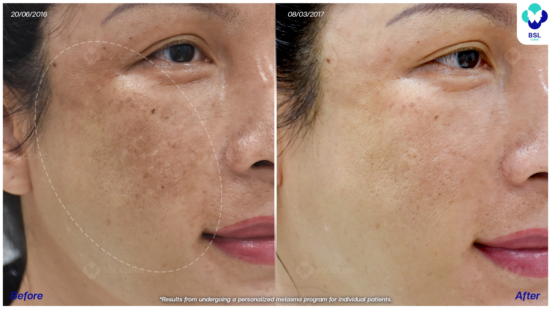 ผลลัพธ์รีวิวรักษาฝ้ากระ