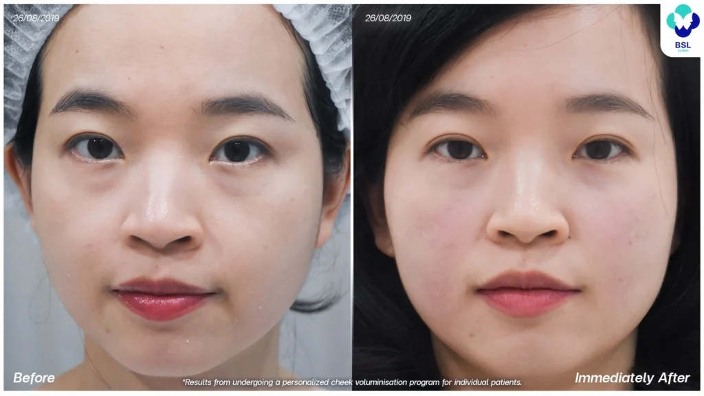 รีวิว ยกกระชับหน้า