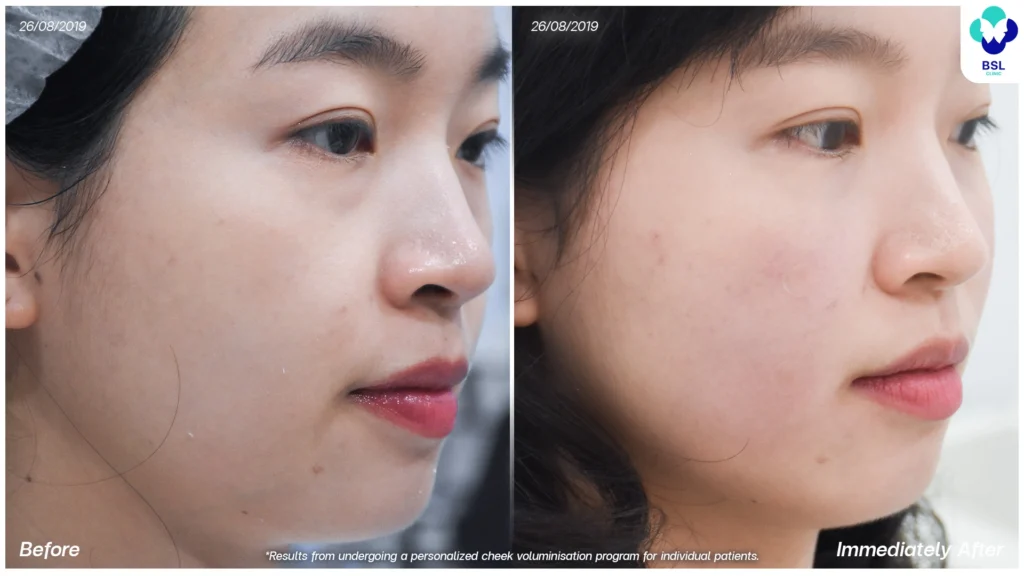 รีวิว ยกกระชับหน้า