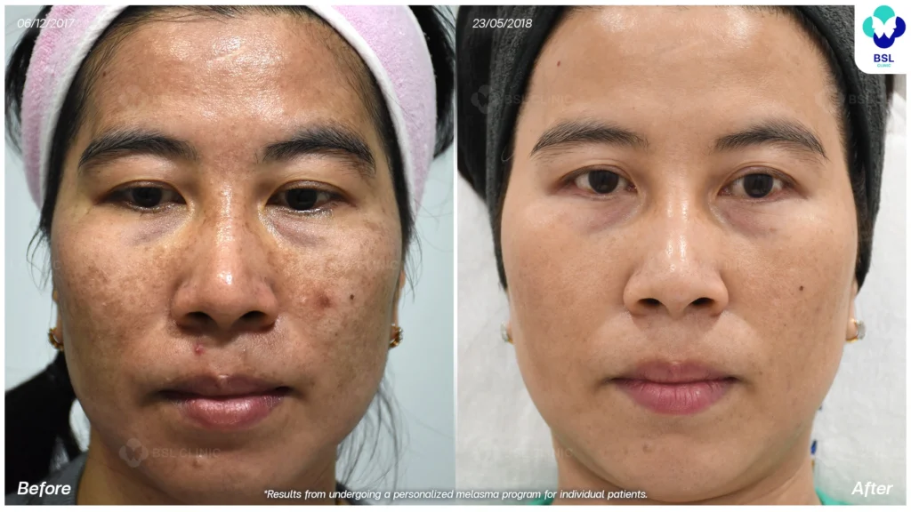 เส้นทางดูแลฝ้าของแต่ละเคส