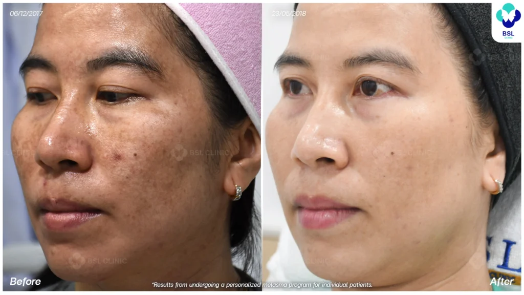 ผลลัพธ์การดูแลฝ้ารอบแก้ม