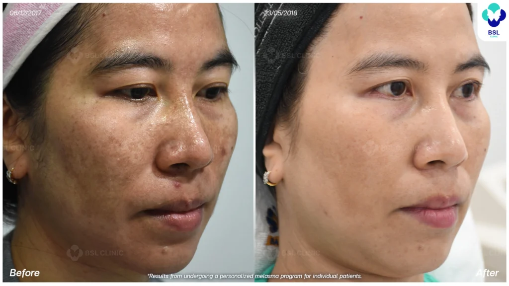 ผลลัพธ์การดูแลฝ้ารอบแก้ม