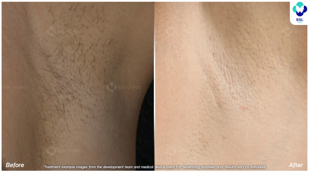 รีวิวรักแร้กระจ่างใสขึ้น