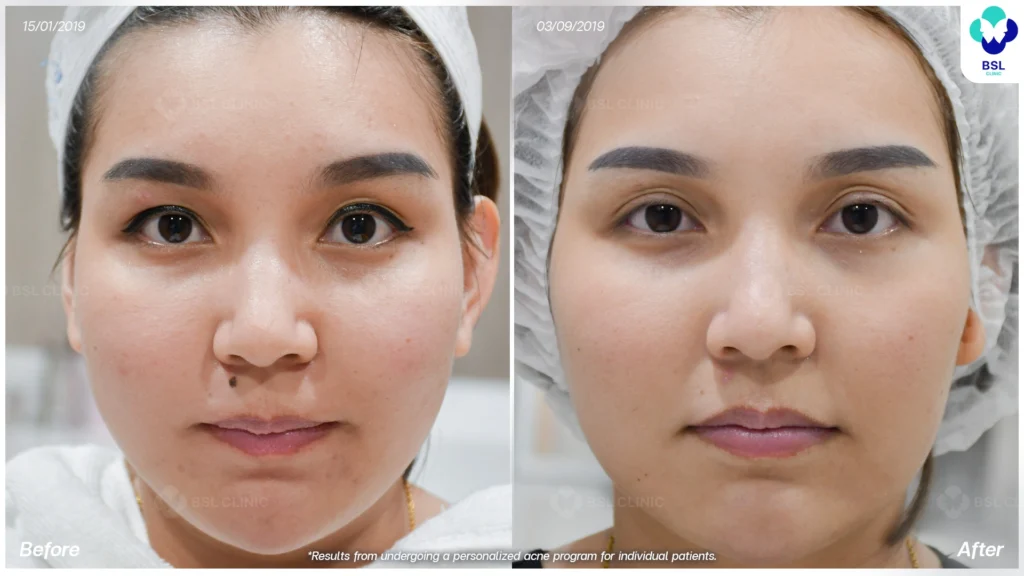 รีวิวรักษาผิวแพ้ง่าย