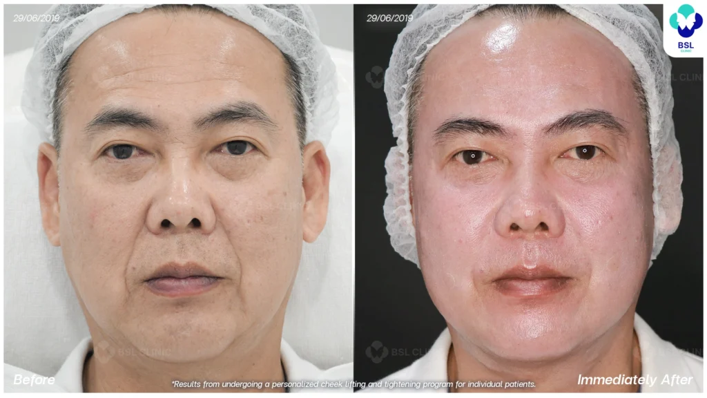 ยกกระชับหน้า